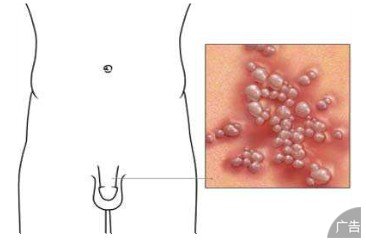 生殖器疱疹的常见危害都有哪些