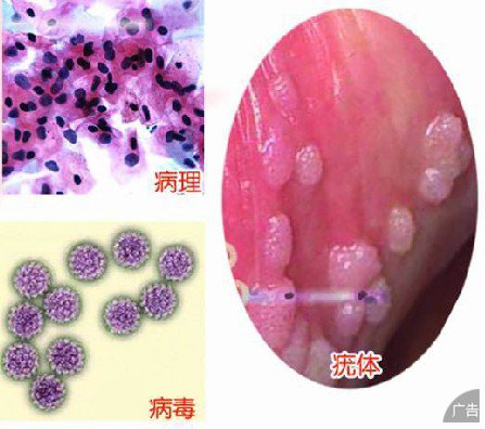 尖锐湿疣主要是通过几个途径感染的