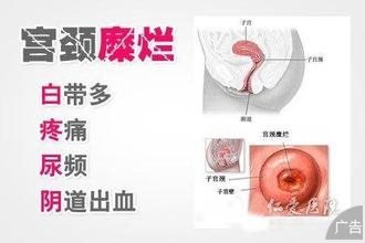 Leep刀治疗宫颈糜烂如何呢？