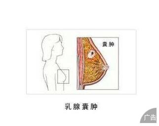 为何会出现双乳腺囊肿