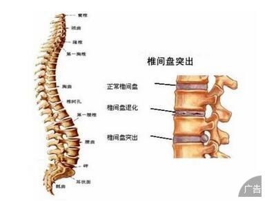 腰椎间盘突出的几大症状你了解吗