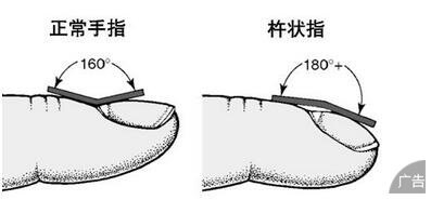 杵状指(趾)的症状是什么