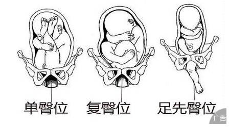 胎位不正能矫正过来吗