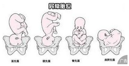 胎位不正还能不能顺产
