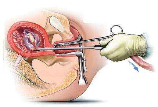 无痛人流手术都有哪些方式
