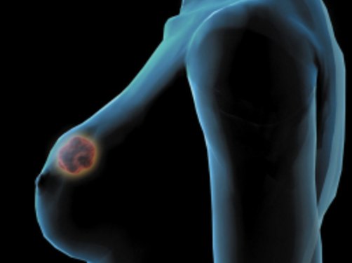 乳腺癌发病因素都有哪些