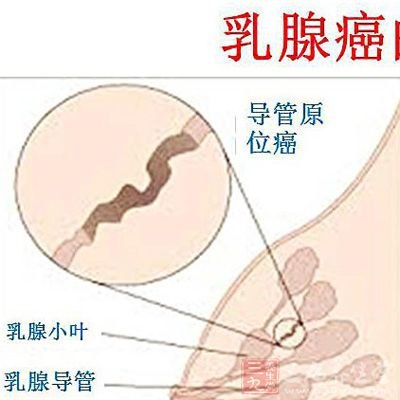 女性应该怎样预防乳腺癌