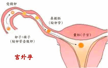 宫外孕手术治疗多少钱