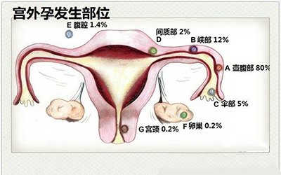 宫外孕治疗哪家医院比较好