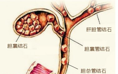 输尿管结石久拖不治有什么危害