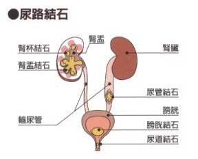 尿道结石的症状都有哪些
