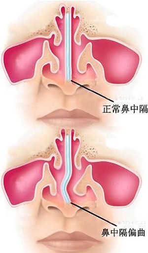 诱发鼻中隔偏曲的病因有哪些