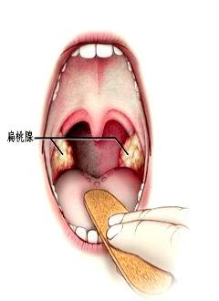 治疗扁桃体炎哪家医院好