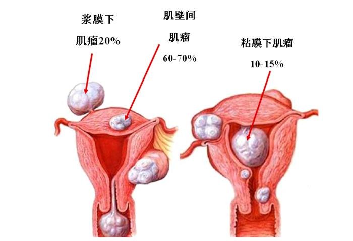 引发子宫肌瘤的原因有哪些