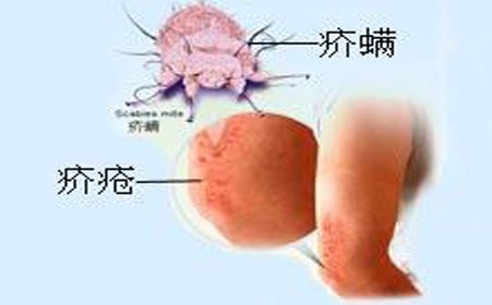 疥疮是什么