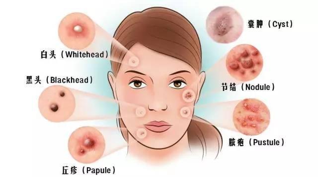 怎么才能快速去除痤疮