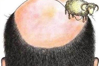 脱发诊断要点有哪些