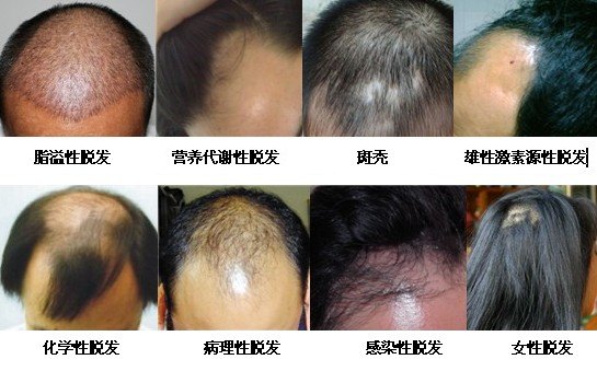 脱发给患者带来的危害有哪些