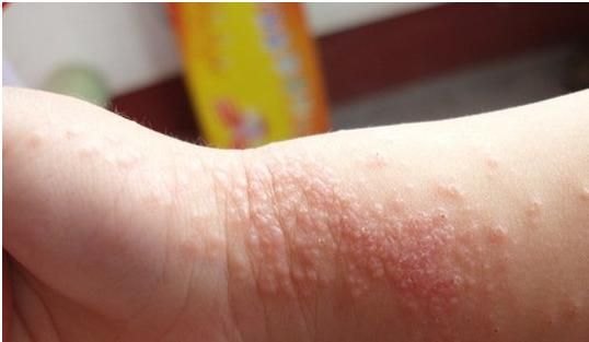 湿疹该如何分型治疗