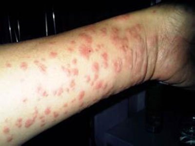 湿疹有哪些明显的症状表现